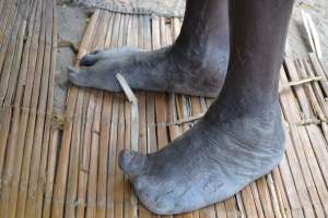 Leprosy affected feet (2)
